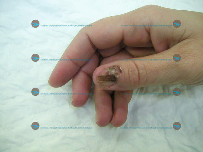 Zehennagel dunkler fleck unterm Nagelverfärbungen: Blauer